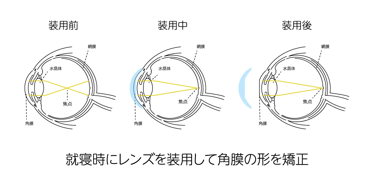 就寝時にレンズを装用して角膜の形を矯正