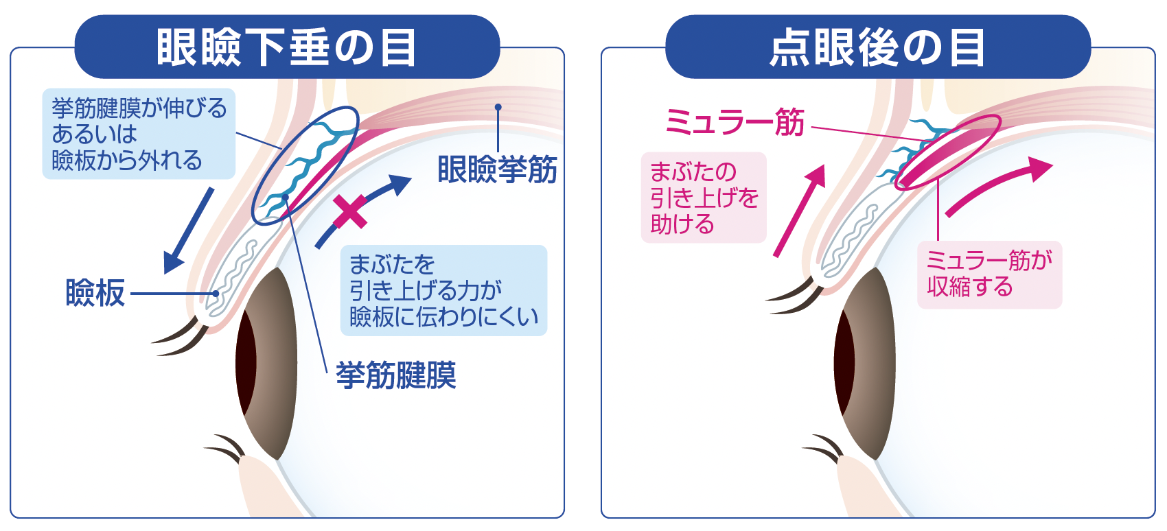 眼瞼下垂の目と点眼後の目の仕組み